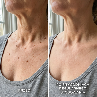 DermaSmooth 40 — Krem keratolityczny z mocznikiem 40% na zrogowacenia i zgrubienia