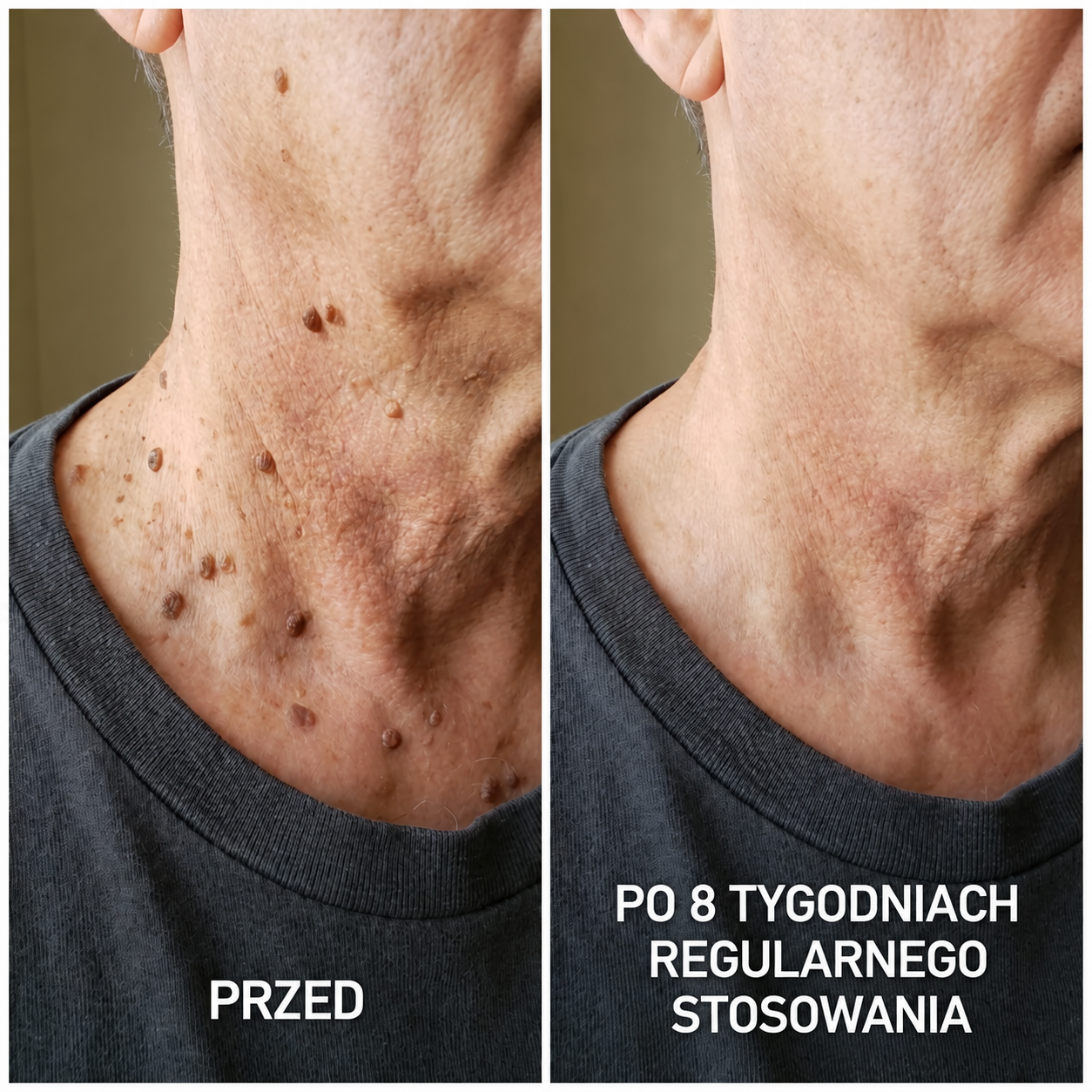 DermaSmooth 40 — Krem keratolityczny z mocznikiem 40% na zrogowacenia i zgrubienia