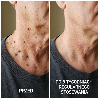 DermaSmooth 40 — Krem keratolityczny z mocznikiem 40% na zrogowacenia i zgrubienia