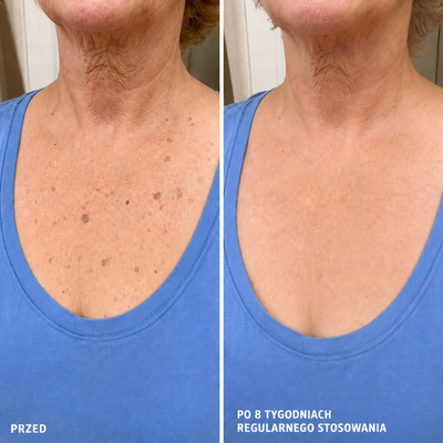 DermaSmooth 40 — Krem keratolityczny z mocznikiem 40% na zrogowacenia i zgrubienia